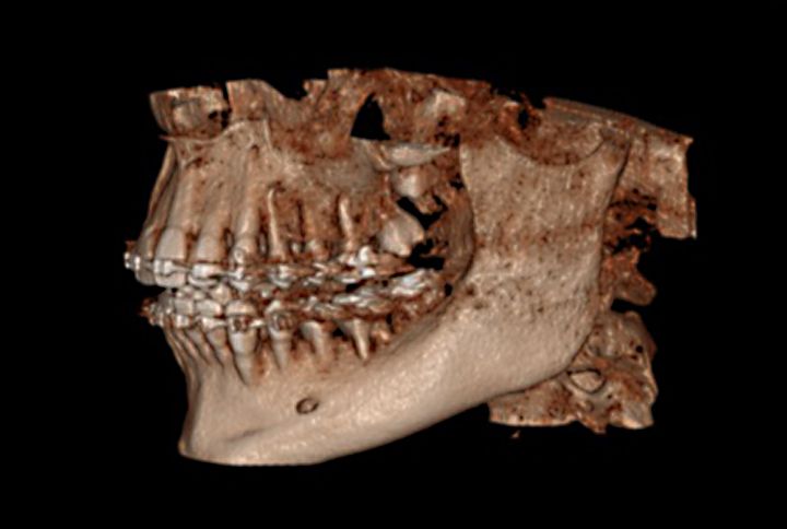 3D-Darstellung von Ober- und Unterkiefer aus einer DVT-Aufnahme