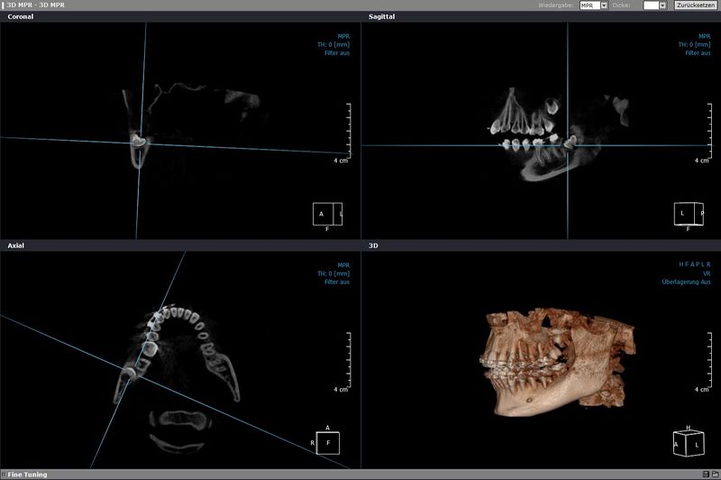 Bildschirmansicht einer DVT-Auswertung mit drei Schnittebenen und einer 3D-Darstellung von Ober- und Unterkiefer